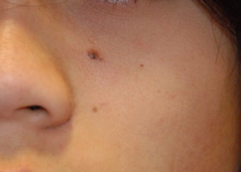 Mole removal 
