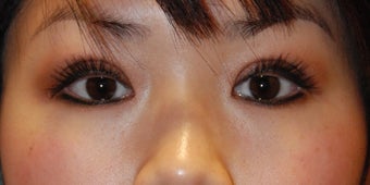 Asian bleph