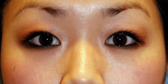Asian bleph