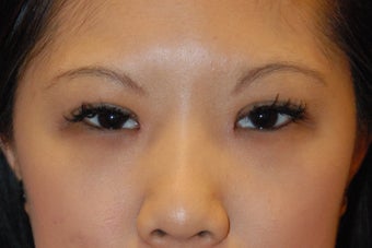 Asian bleph