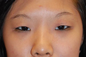 Asian bleph
