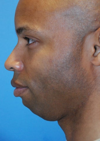 Chin implant