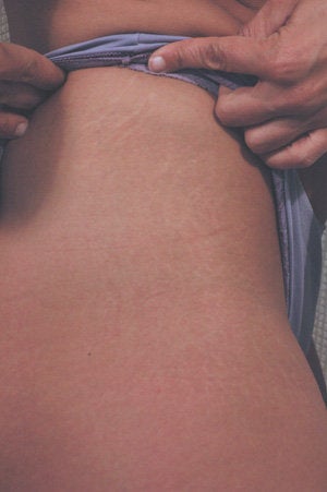 Laser for Stretch Marks