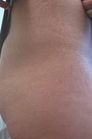 Laser for Stretch Marks