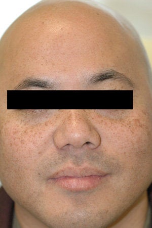Asian Skin Freckle Removal