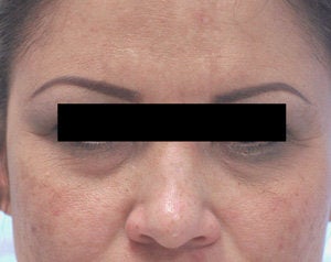 Restylane for eye bags