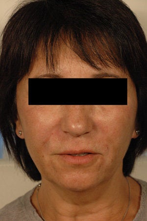 Juvederm for laugh lines