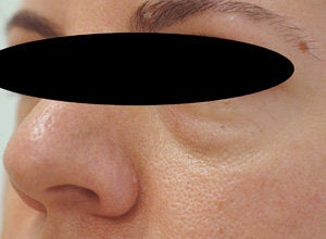 Restylane for eye bags