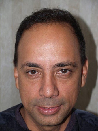Hair Transplant - 3400 grafts