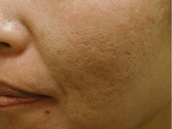 Acne Scars