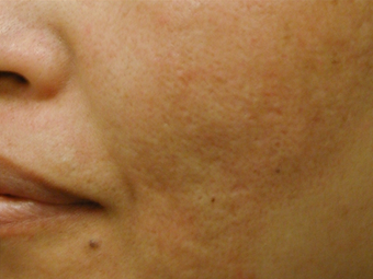 Acne Scars