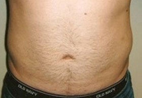 Liposuction