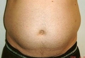 Liposuction