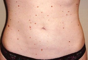 Liposuction