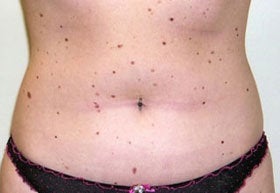 Liposuction