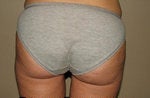 Liposuction