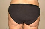 Liposuction