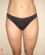 Liposuction