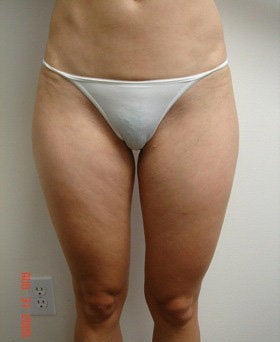 Liposuction
