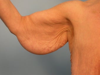 Arm Lift / Brachioplasty