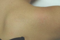 Laser Tattoo Removal