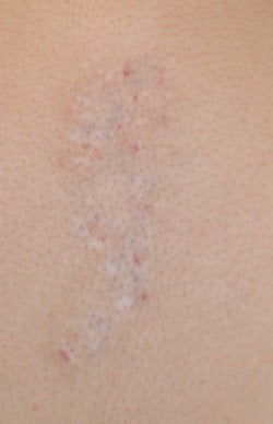 Long Beach Laser Tattoo Removal 