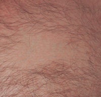 Chest Tattoo Removal - Lasers 