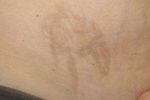 Laser Tattoo Removal Photos