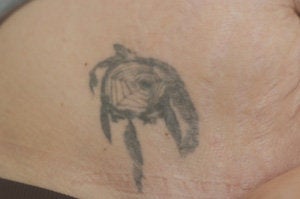 Laser Tattoo Removal Photos