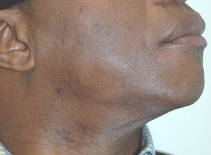 Laser Hair Removal Dark Skin 