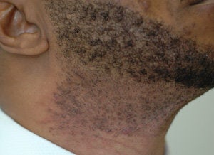 Laser Hair Removal Dark Skin 