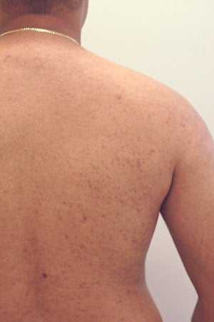 Permanent Back Hair Removal with Lasers 