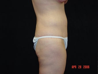 Body Lift with Liposuction of Abdomen, Waist, and Flanks