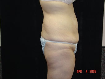 Body Lift with Liposuction of Abdomen, Waist, and Flanks