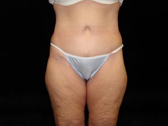 Body Lift with Liposuction of Abdomen, Waist, and Flanks