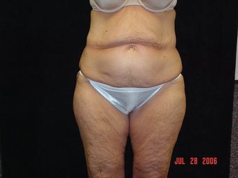 Body Lift with Liposuction of Abdomen, Waist, and Flanks