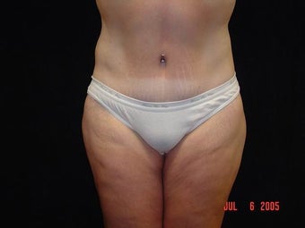 Body Lift with Liposuction of Abdomen, Waist, Flanks