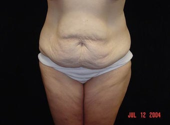 Body Lift with Liposuction of Abdomen, Waist, Flanks