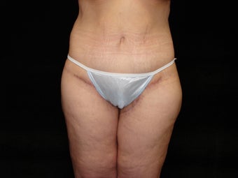 Body Lift, Outer Thigh Lift, Buttocks Lift