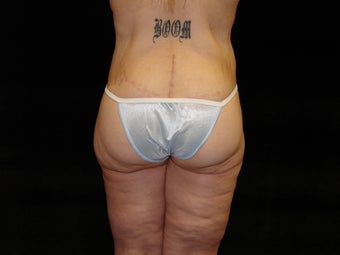 Body Lift, Outer Thigh Lift, Buttocks Lift