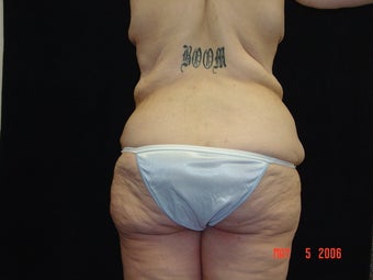 Body Lift, Outer Thigh Lift, Buttocks Lift