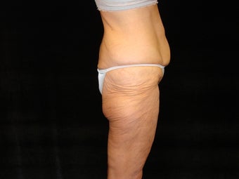 Body Lift with Liposuction of Abdomen, Waist, and Flanks