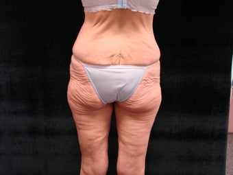 Body Lift with Liposuction of Abdomen, Waist, and Flanks