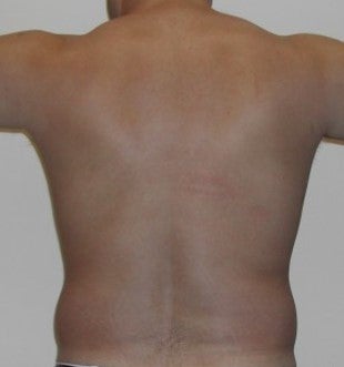 Liposuction love handles