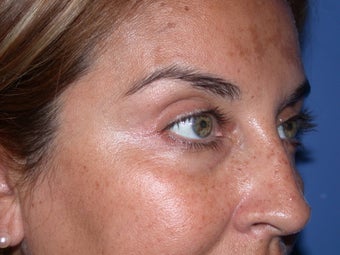 Botox