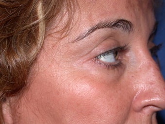 Botox