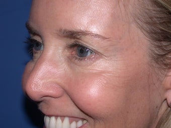 Botox