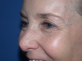 Botox