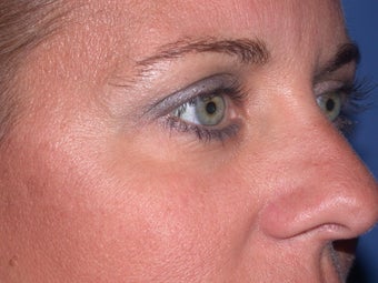 Botox