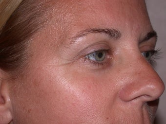 Botox